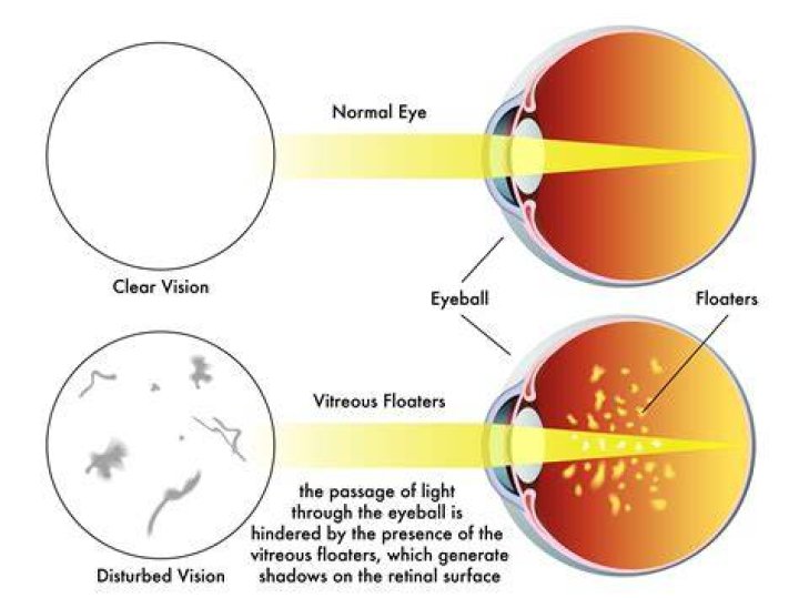 When should I worry about eye floaters?