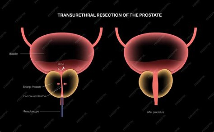 When should you have your prostate removed?