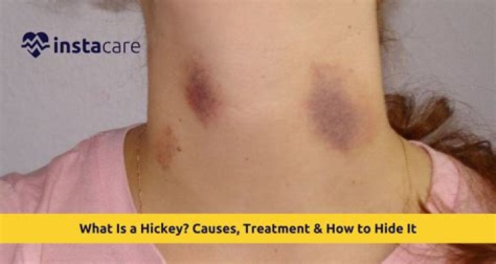 Where do hickeys feel the best?