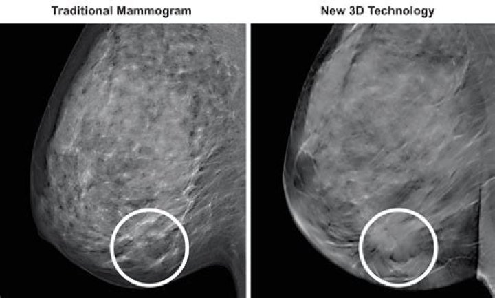 Which is more accurate 3D mammogram or ultrasound?