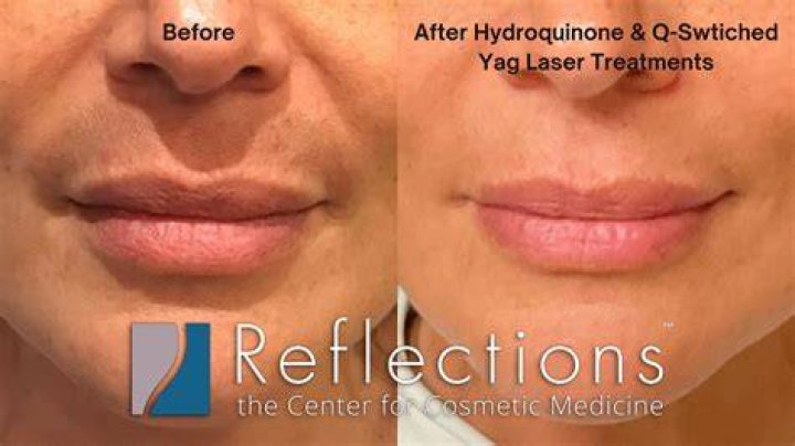 Which laser is best for dark spots?
