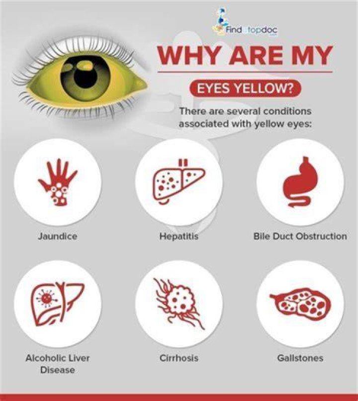 Why are the corner of my eyes yellow?