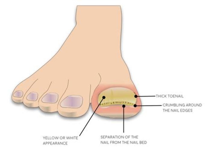 Why do I have a second toenail?