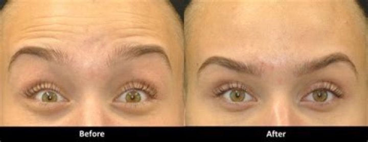 Why do my eyebrows feel heavy after Botox?