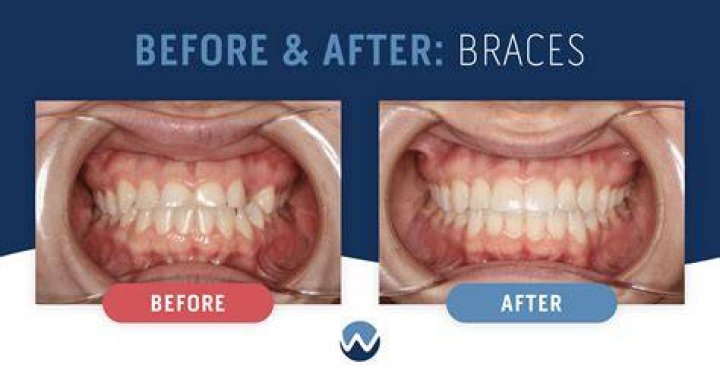 Why do my teeth look weird after I get my braces off?
