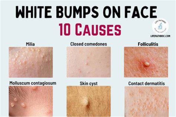 Why do pimples come on face?
