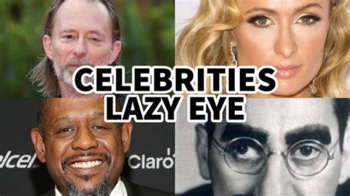 Why do so many actors have lazy eyes?