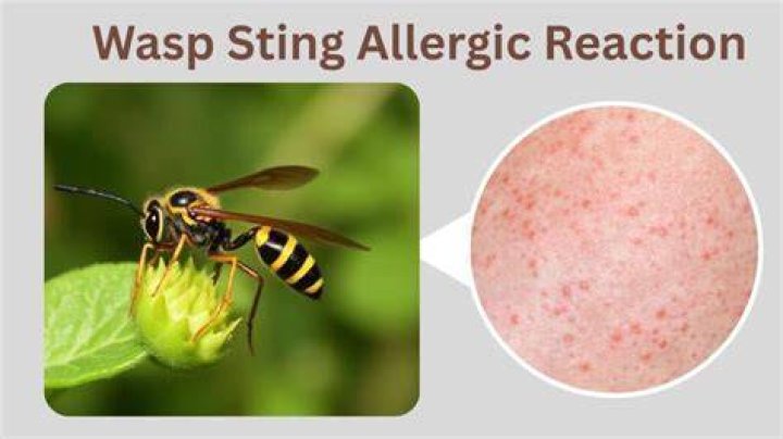 Why do wasp stings hurt?