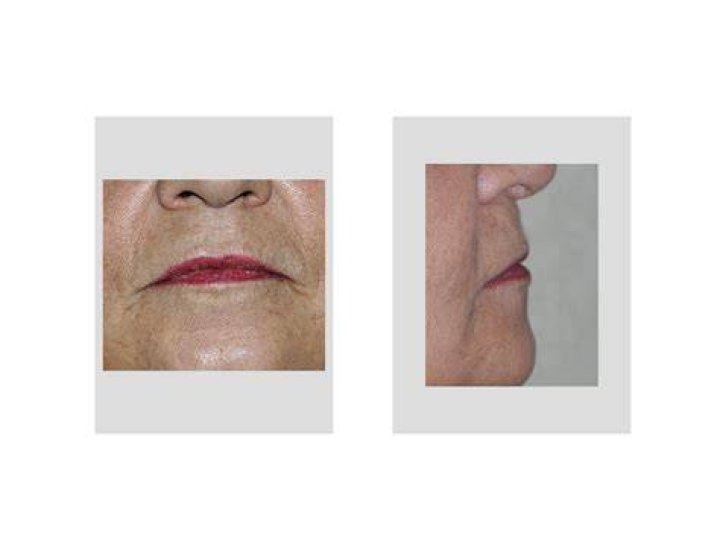Why do women's lips thin with age?