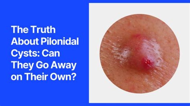 Why does a cyst keep filling up?