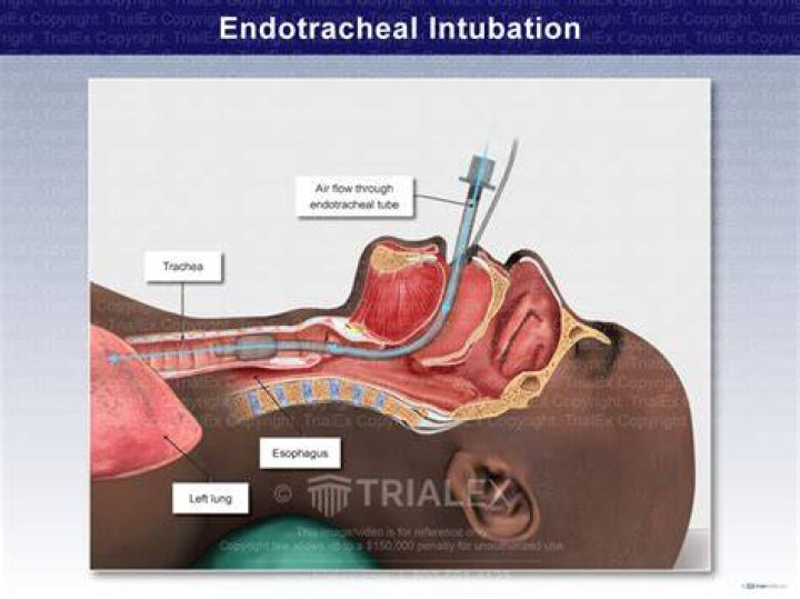 Why does intubation hurt?