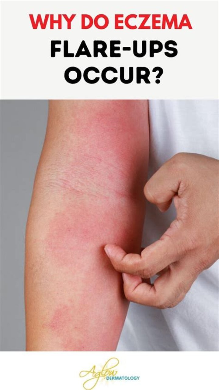 Why does my eczema flare-up after a shower?