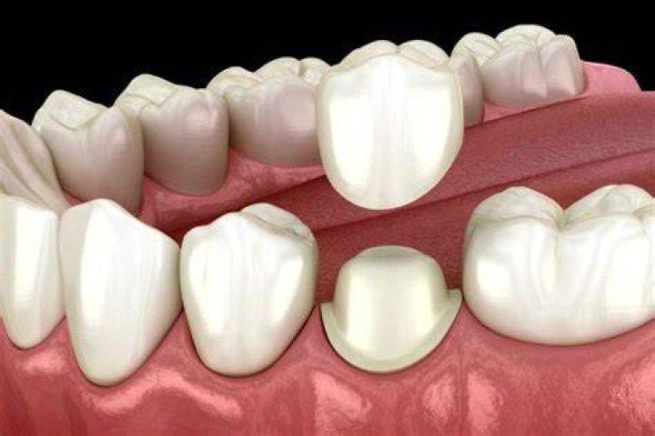 Why does my new crown hurt when I put pressure on?