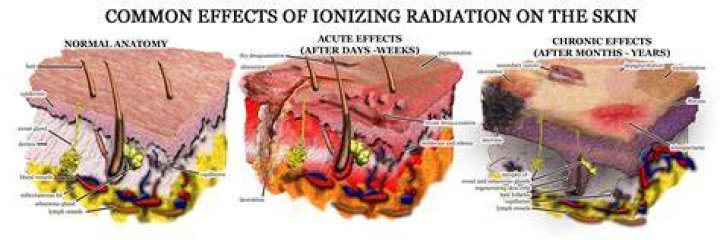 Why does radiation burn skin Chernobyl?