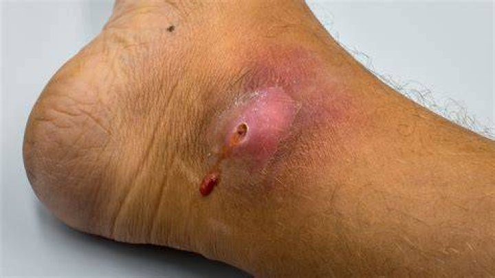 Why is my wound white?