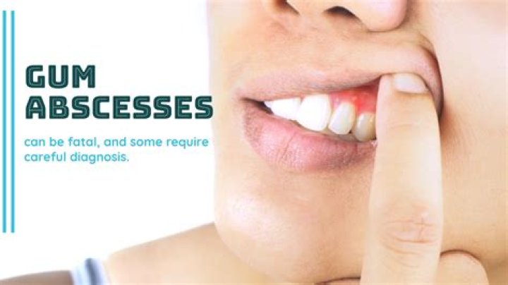 Will a gum abscess pop on its own?