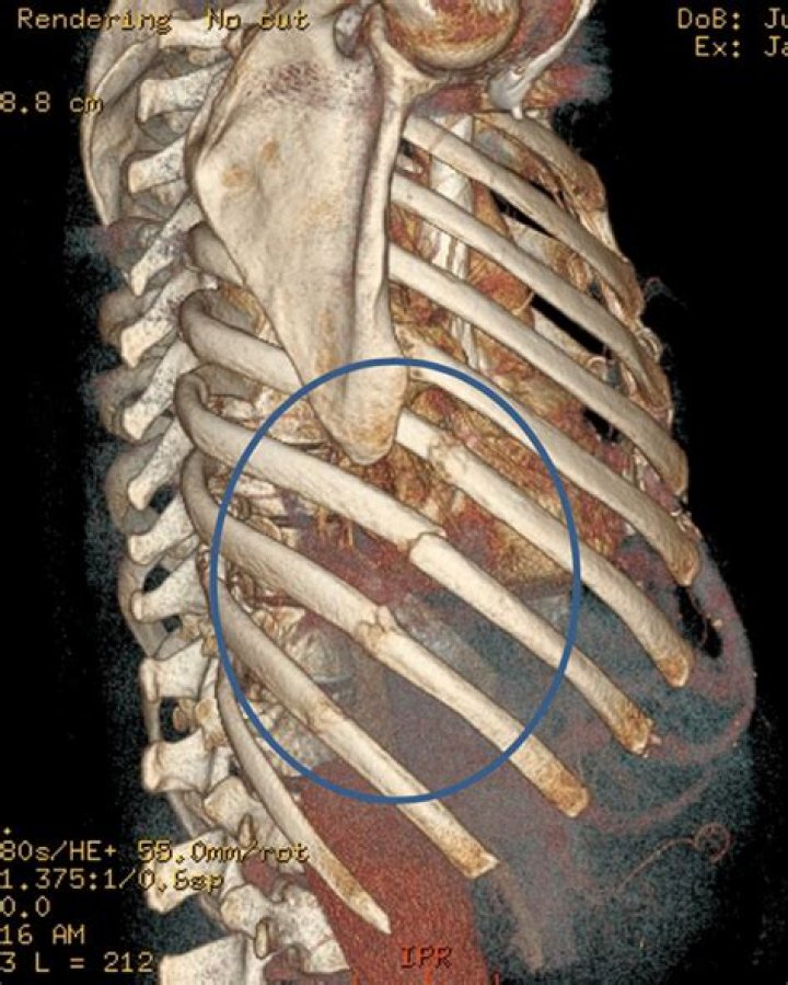 Will a popped rib heal itself?